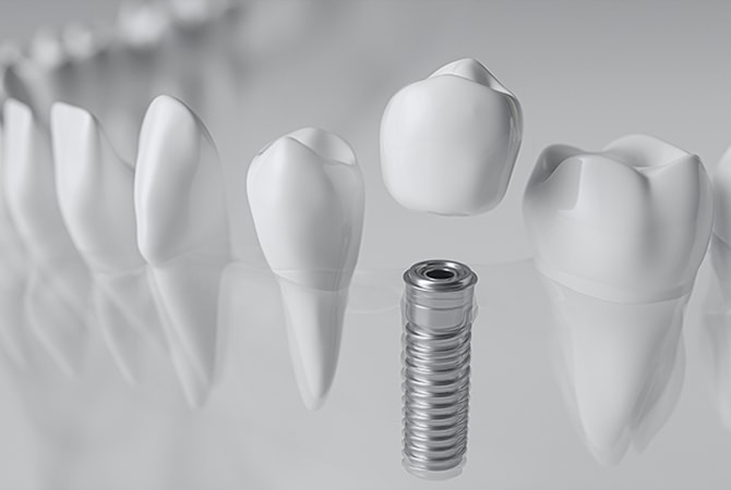 dental-implant2