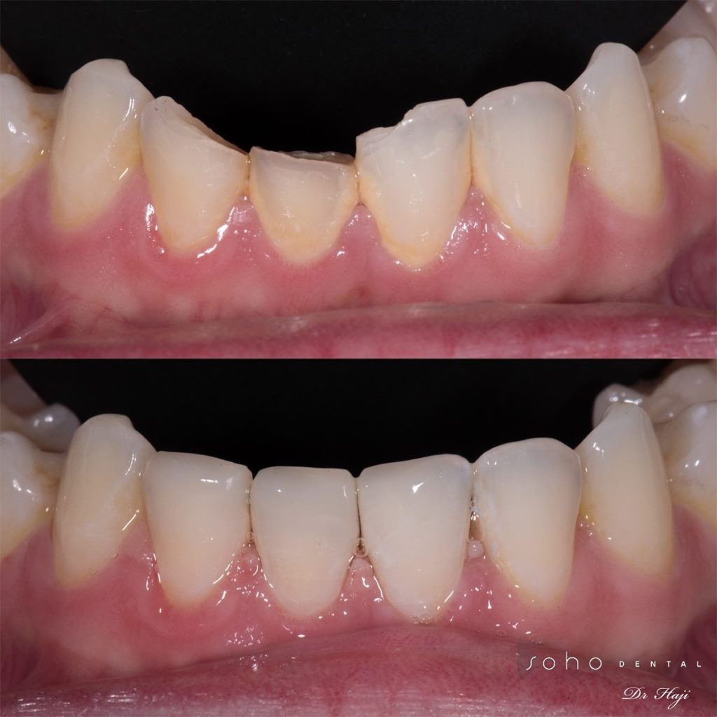 Before and after image for dental bonding