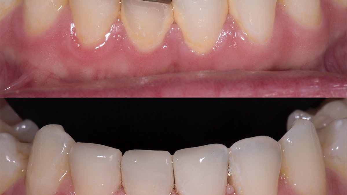 Before and after image for dental bonding